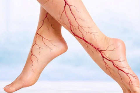 Можно ли летать на самолете при варикозе