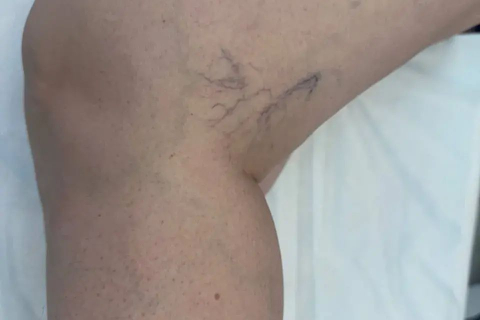 Результат склеротерапии&nbsp; устранение сосудистых сеток и варикозных вен