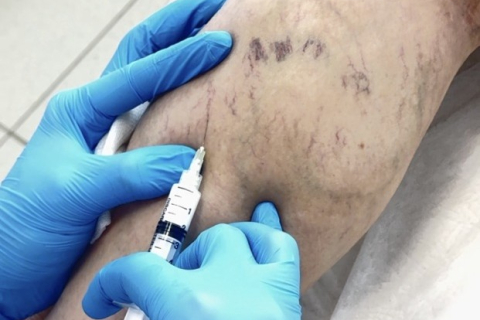 Удаление варикозных вен и сосудистых сеток - результат после склеротерапии