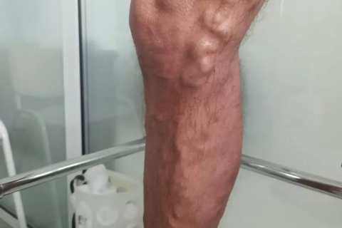 Лечение варикозной болезни - результат через 45 дней и 6 месяцев после ЭВЛК